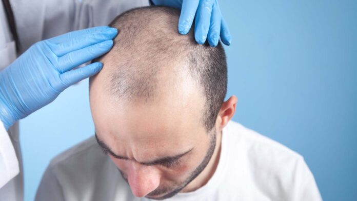 Best Hair Transplant in Chandigarh Best Hair Transplant in Chandigarh